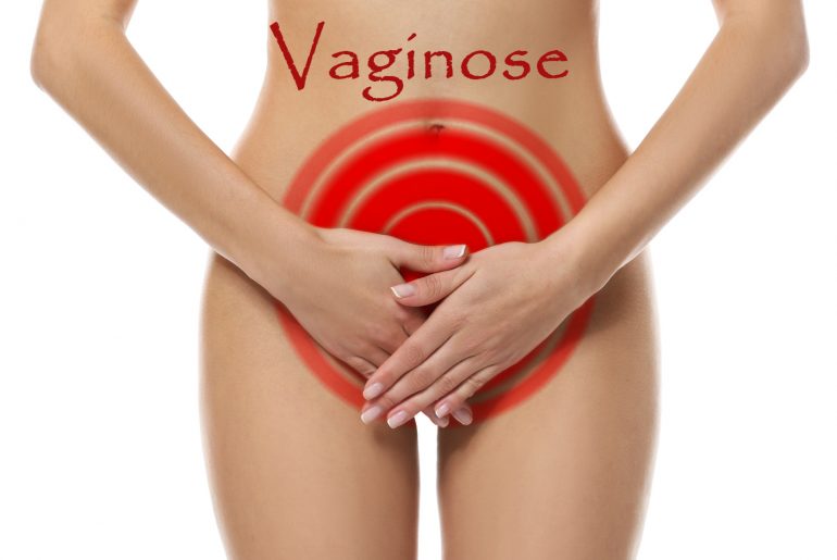 vaginose